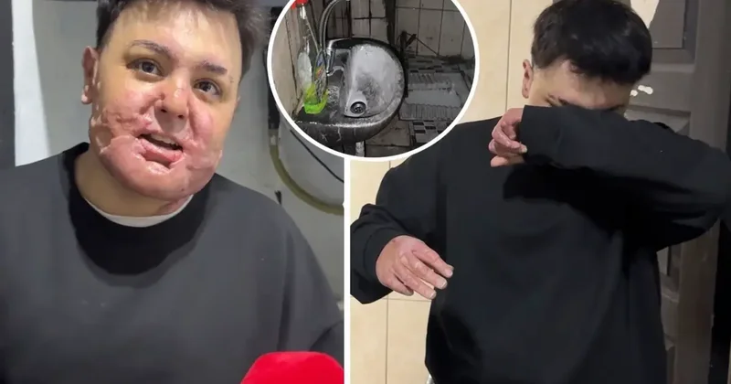 65 ameliyat geçirdi, 12 gün uyutuldu! Hayatı saniyeler içinde kabusa döndü