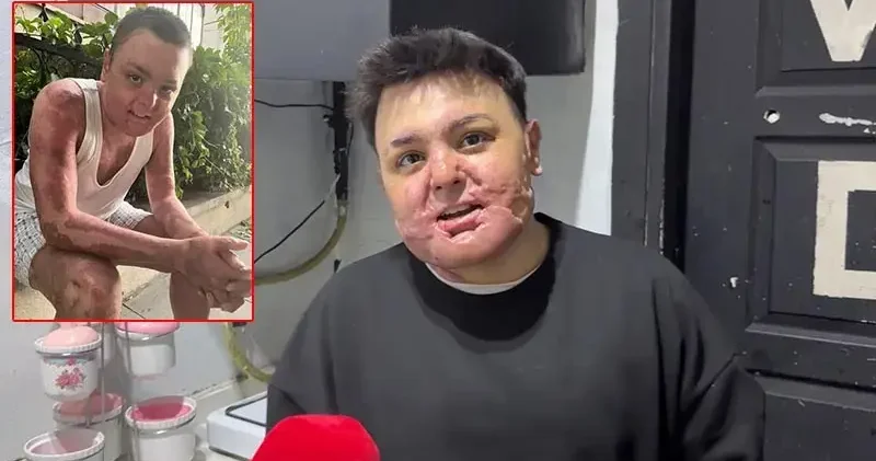 Kağıthane’de kuafördeki yangında vücudu yanan 15 yaşındaki Engin: Mücadeleyi kesinlikle bırakmasınlar ben yılmadım