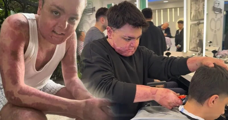 Ölümden döndü pes etmedi: 65 operasyon sonrası hayata sımsıkı tutundu