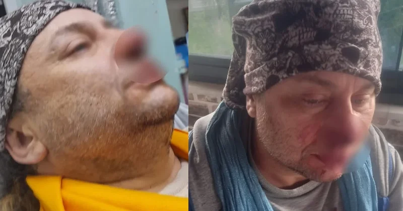 Felaket Tellalı lakaplı ünlü ismin pitbull saldırısında burnu koptu Sözcü Gazetesi