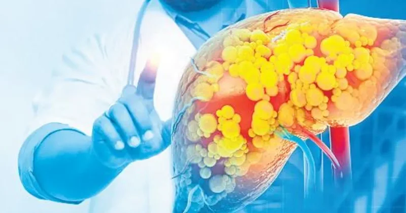 Karaciğer hastalıklarında korkutan artış