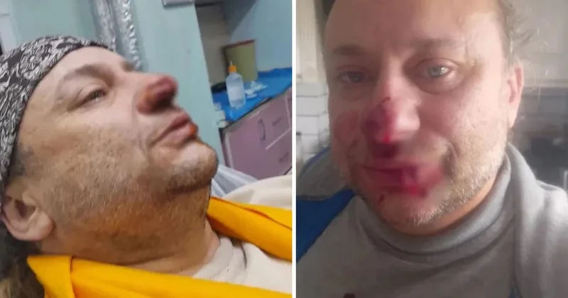 Onur Akay, başıboş pitbull köpeğinin saldırısında yaralandı