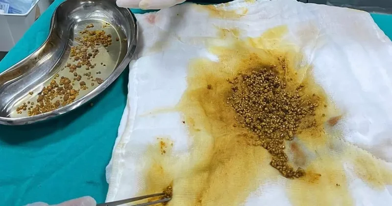 Karın ağrısıyla gitti, çıkanlar şok etti! Safra kesesinden 2 bin 67 taş çıkarıldı