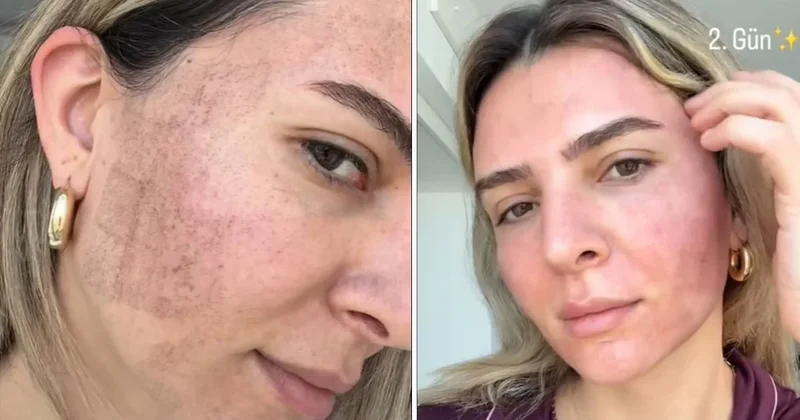 Cildine ışın gönderdi, ortaya çıkan değişim şaşırttı: Merve Aydın bile kendine inanamadı Sözcü Gazetesi