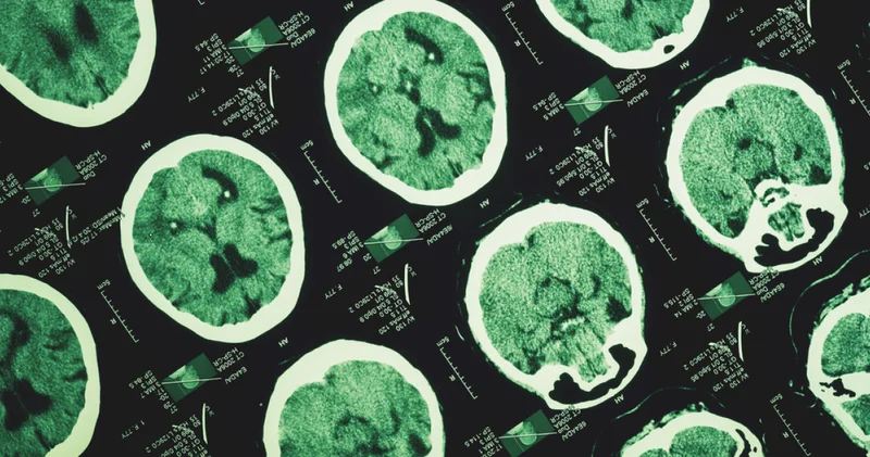 Alzheimer unutkanlıkla başlamıyor! İşte yıllar önce başlayan izler Haberler
