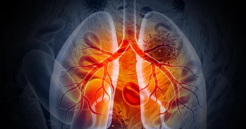 Elektronik sigarayı sigara ile birlikte kullananların akciğer kanseri riski sadece sigara içen gruba göre 4 kat artıyor Sağlık Haberleri