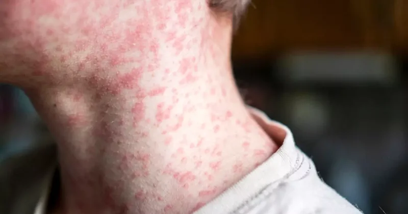 Kızamık salgını başkenti alarma geçirdi: 7 okul harekete geçti! 60 çocuğa bulaştı