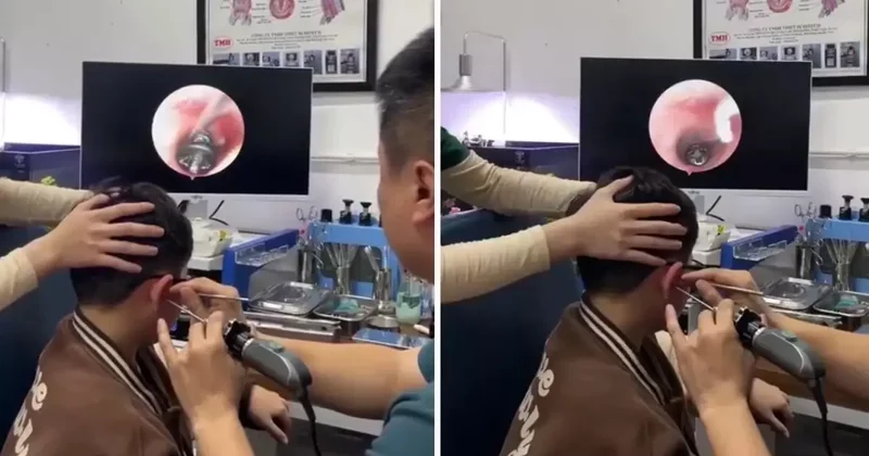 Küçük çocuğun kulağından çıkana, doktorlar bile şaştı kaldı