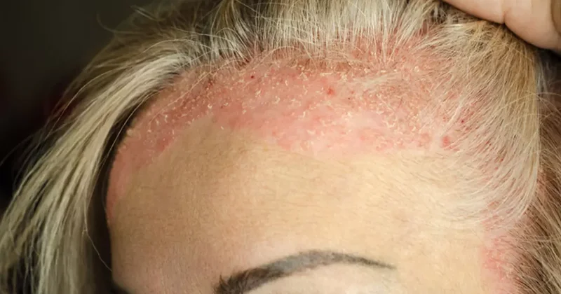 Kaşıdıkça artan tehlike: Soğuk hava egzamayı tetikliyor mu?