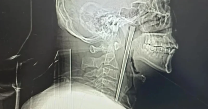 Çoğu insan saniyeler bile dayanamazdı: 12 santimetreyle tam 8 yıl yaşadı