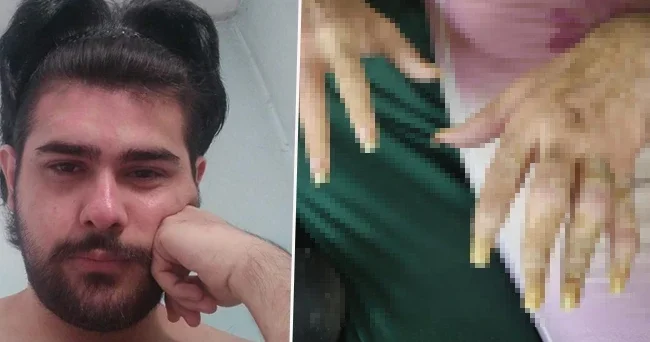 3 yıldır evden dışarı çıkmıyor, tırnaklarını kesmiyordu! Eski hali ortaya çıktı Arkadaşı Barış ın değişimini anlattı