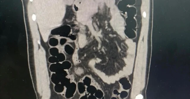 Midesinden 89 kapsül uyuşturucu çıktı Bolu Haber Habertürk Yerel Haberler