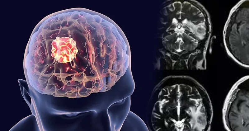 Kaç çeşit beyin tümörü var? Profesör açıkladı