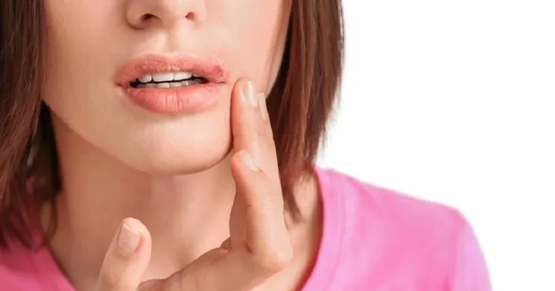 Dudaklarda uçuk meğer bu yüzden çıkıyor Sözcü Gazetesi