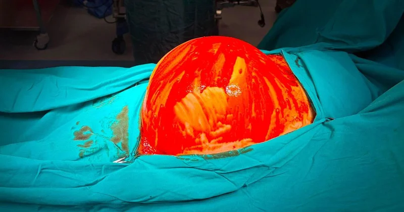 Halsizlik şikayetiyle hastaneye gitti, karnından 6,5 kilogramlık tümör çıktı