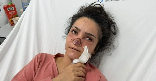 Eşi tarafından burnu ısırılıp koparılan İmran: Canımın acıyla balkondan atlamayı bile düşündüm Manisa Haberleri Habertürk Yerel Haberler