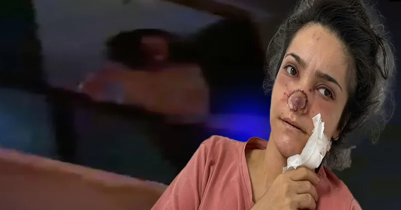 Manisa da cani koca dehşeti! Tartıştığı eşinin burnunu koparmıştı: Canımın acısıyla balkondan atlayacaktım!