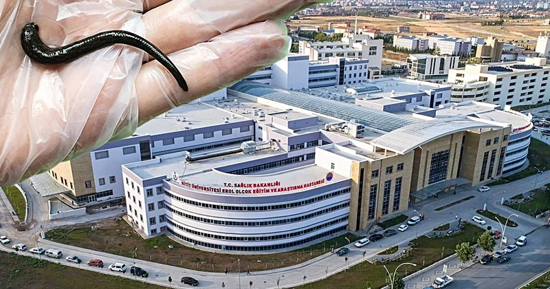 Çorum da bir hastanın boğazından canlı sülük çıkarıldı