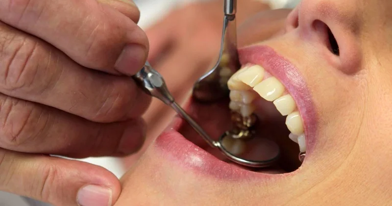 Basit bir diş çürüğü nelere yol açabiliyor?