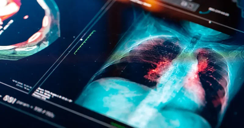 Türkiye de her yıl 4 bin yeni vaka! Bu illere dikkat: Risk daha fazla!