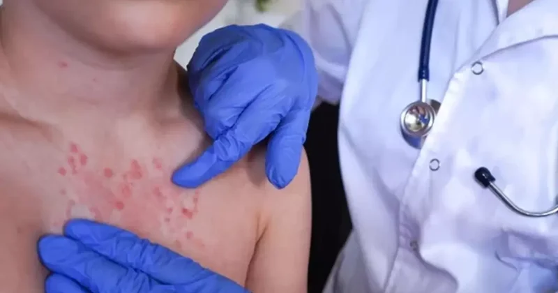 Vakalar son 30 yılda pik yaptı! İki haftada ortaya çıkıyor, 3 yıl kadar sürüyor