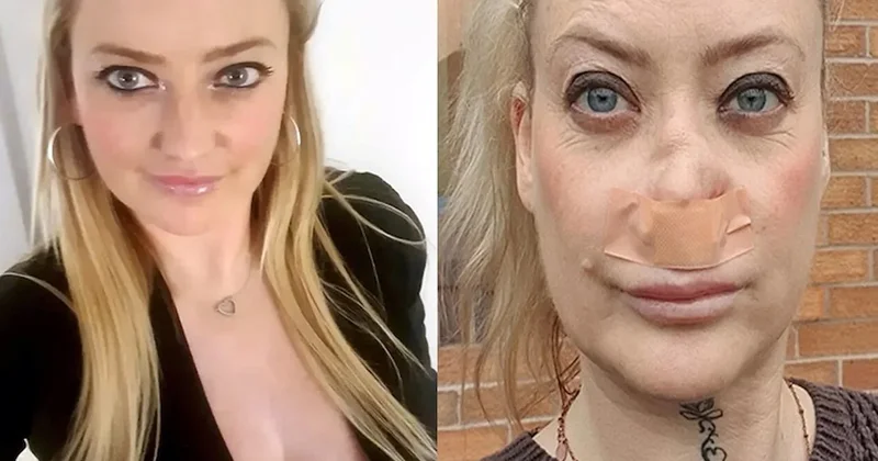 Antalya tatilinde dişlerini yaptıran turistin burnu çöktü! Sözcü Gazetesi