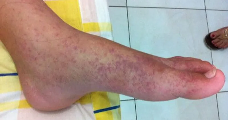 Küresel ısınma, ölümcül bir salgının temelini hazırlıyor Sözcü Gazetesi