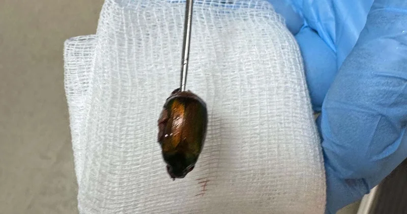 Kulağındaki ağrının nedeni şaşkına çevirdi! Doktorlar Japon böceği çıkardı