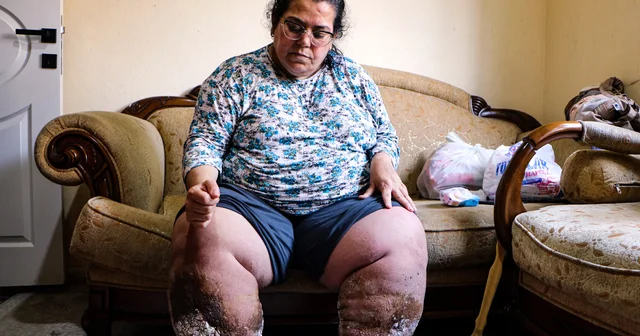 Fil hastası kadın, iyileşip çocuklarıyla ilgilenmek istiyor Adana Haberleri Habertürk Yerel Haberler