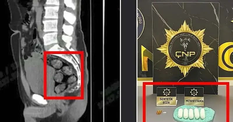 İran dan midesinde getirdiği 173,15 gram metamfetamin ile yakalandı