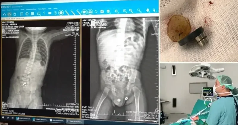 1,5 yaşındaki çocuğun yuttuğu cisim bağırsaklarını deldi: Ameliyatla sağlığına kavuştu Gündem Haberleri