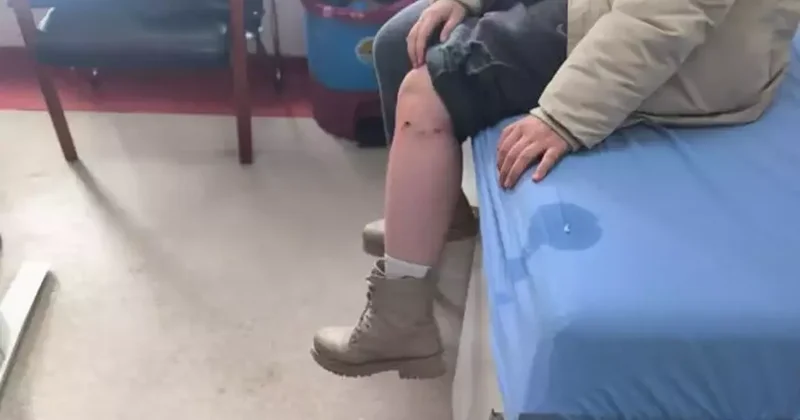 Kayseri’de sokak köpeğinin saldırısına uğrayan çocuk yaralandı