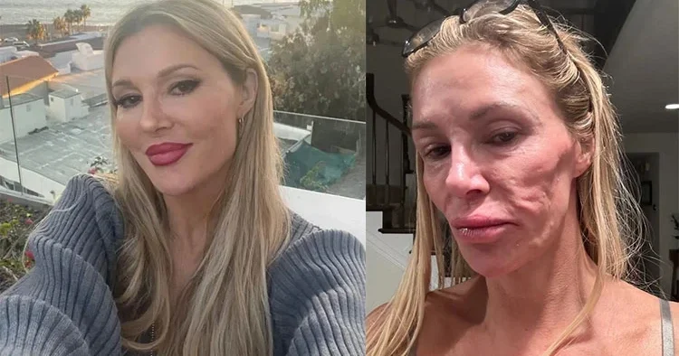 Güzellik hevesi kabusla bitti… Yüzü tanınmaz hale geldi: Bir gecede 20 yıl yaşlandım