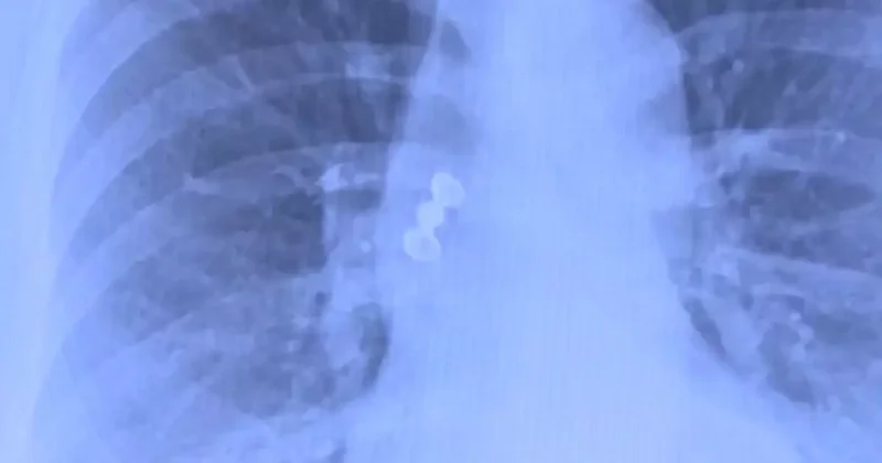 Sabah uyandı, dişleri yoktu! Röntgeni gören doktorlar şok oldu