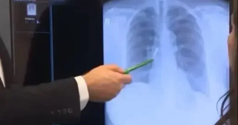 Kaplama dişleri uyurken akciğerine kaçtı Sözcü Gazetesi