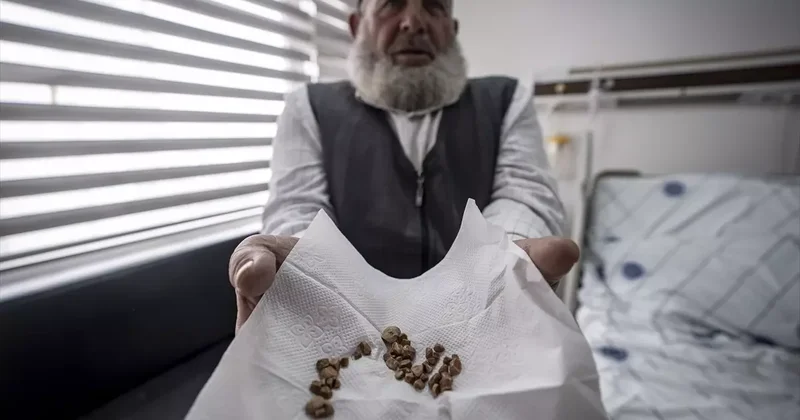 2 çocuk annesi kadının vücudundan çıkarıldı! Tam 51 tane... İlk kez gördüm