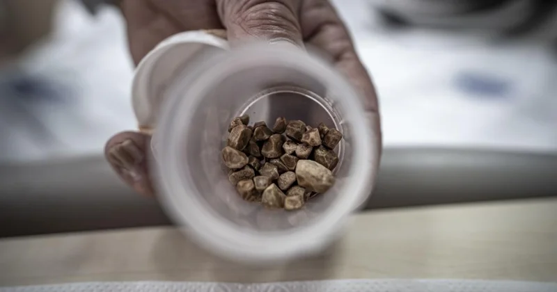 İdrar kanalından 51 taş çıkarıldı