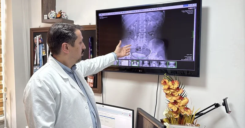 İdrar kanalından çıkan 51 taş, doktorları bile şaşkına çevirdi