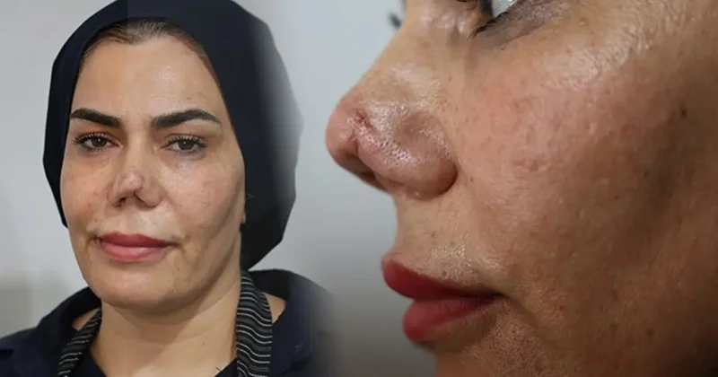 Elazığ da kaza ile başlayan kabus! Kırılan burnu, 4 operasyonun ardından yırtıldı