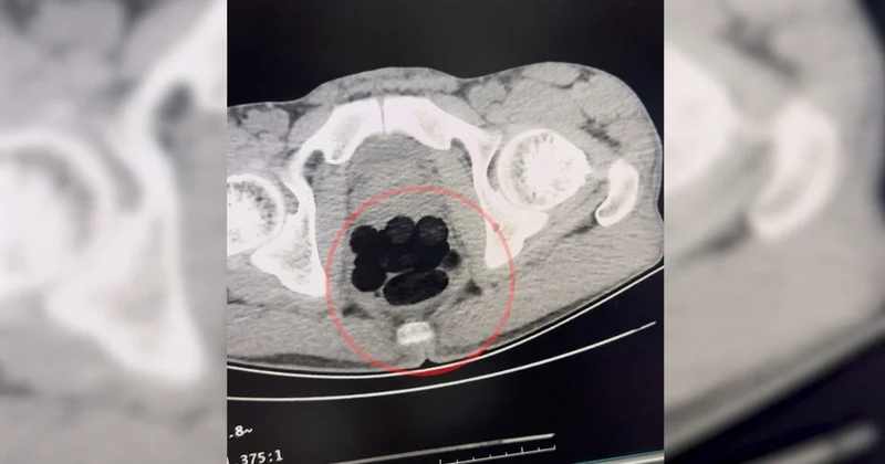 Narkotik ekipleri otobüsü durdurdu, şüphelinin midesinden 253 gram eroin çıktı