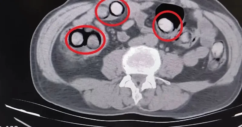 Midesinden çıkan şoke etti! 758 gram uyuşturucuyla yakalandı
