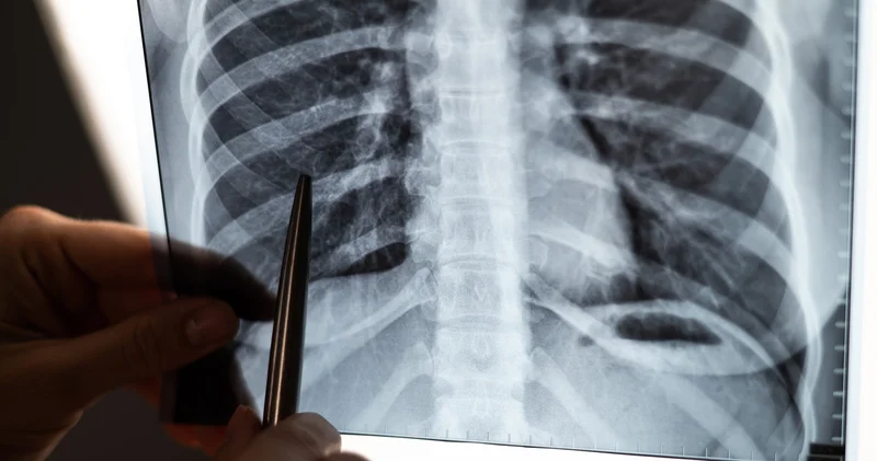 KOAH hastalarının çoğu KOAH olduğunu bilmiyor Sağlık Haberleri