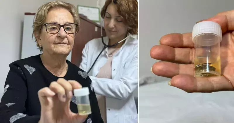 Alüminyum kabıyla yuttuğu hap, 4 yıl sonra akciğerinden çıkarıldı