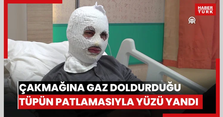 Çakmağına gaz doldurduğu tüpün patlamasıyla yüzü yandı