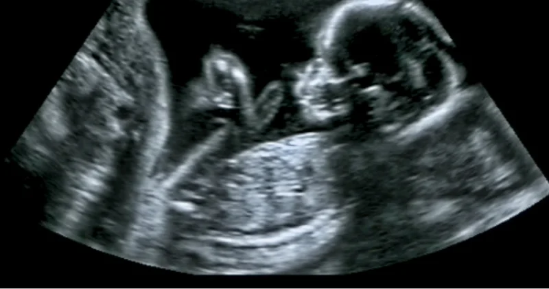 Kalp ve damar sağlığı anne karnında başlıyor Sağlık Haberleri