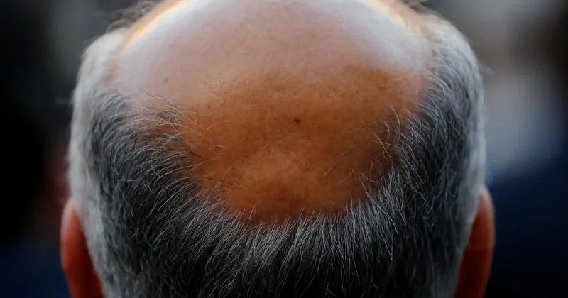 Dünya kellik haritası açıklandı: Türkiye’nin sırası dikkat çekti Sözcü Gazetesi