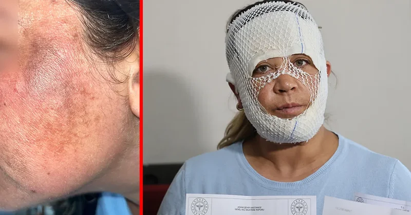 Adana’da Prenses cilt bakımı kabusu oldu! Güzellik uğruna hayatı karardı: Çocuğum ‘öcü’ diyerek benden kaçıyor