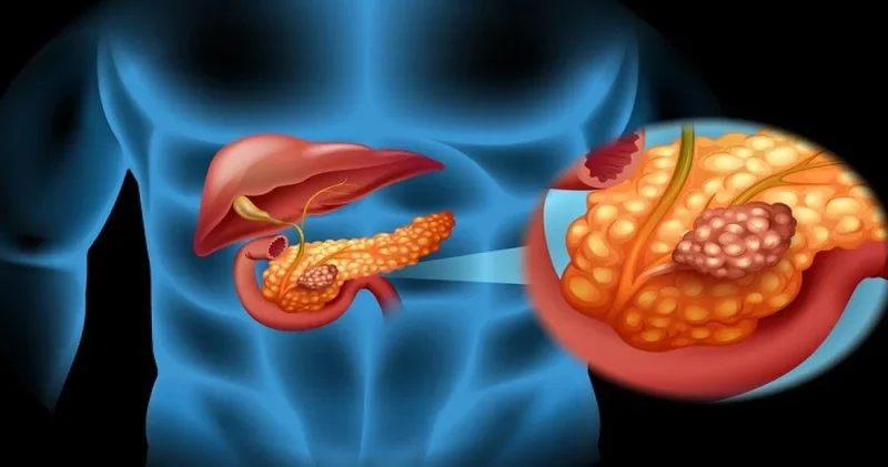 Pankreas kanseri teşhisinde korku dönemi bitiyor mu? Yeni ilaçla yaşam süresi ikiye katlandı!