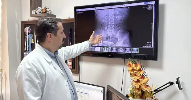 Erzurum haberleri İdrar kanalından çıkan 51 taş doktor, hasta ve yakınlarını şaşırttı 19 Nisan 2026