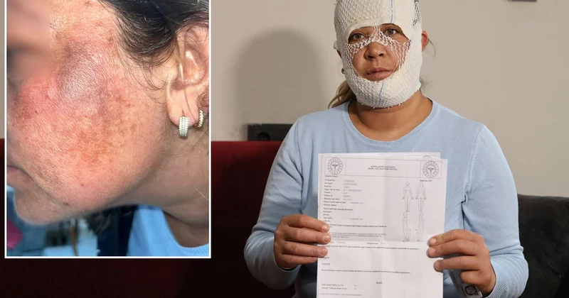 Prenses cilt bakımı yüzünü yaktı: Oğlum öcü deyip benden kaçıyor